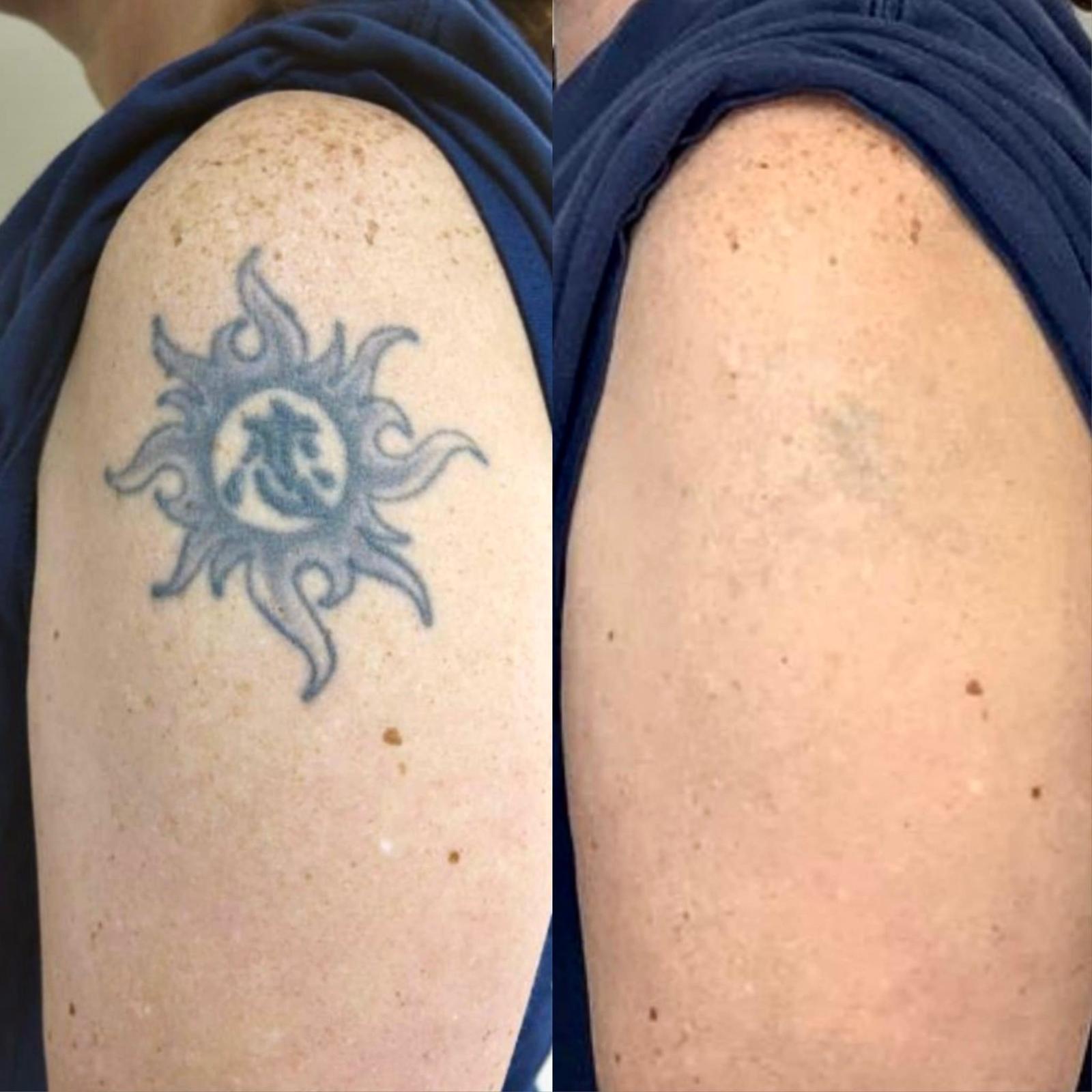 Tattoo Removal