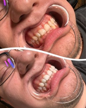 teeth2