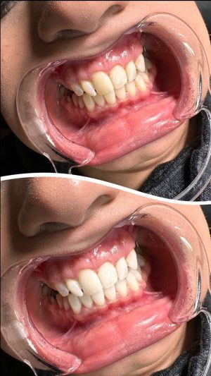 teeth3